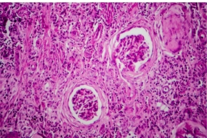 Glomerulonefrite: como esse problema afeta a função dos rins