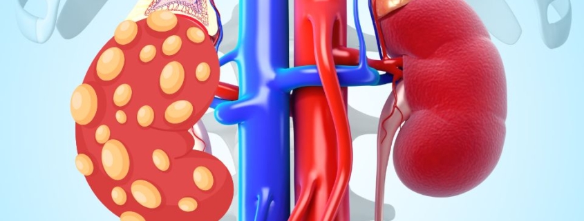 Doença renal policística o que é, causas, sintomas e tratamentos