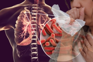 Tuberculose urinária