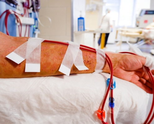 Fístula arteriovenosa cuidados vitais na hemodiálise