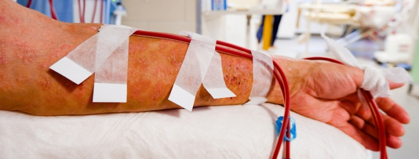 Fístula arteriovenosa cuidados vitais na hemodiálise