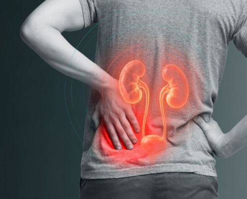 Calculo-renal-ou-nefrolitiase-sintomas-causas-prevencao