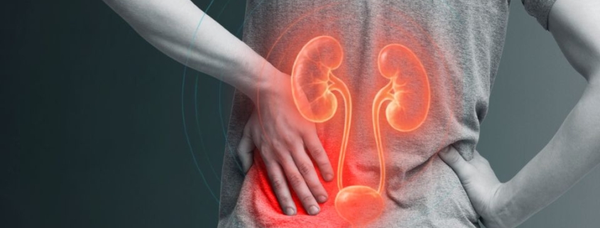 Calculo-renal-ou-nefrolitiase-sintomas-causas-prevencao